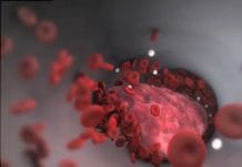 Pulmoner Tromboemboli Olgu Sunumu 65 Yaş Erkek