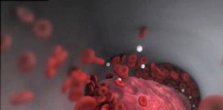 Pulmoner Tromboemboli Olgu Sunumu 65 Yaş Erkek