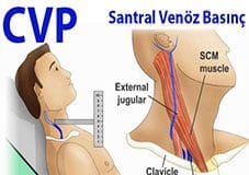 Düşük Santral Venöz Basınçın USG ile Ölçümü
