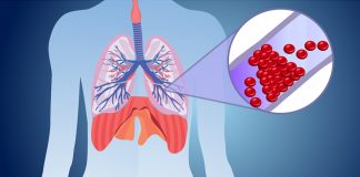 Akut Pulmoner Emboli Tanı ve Tedavi Kılavuzu (ESC 2014)