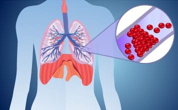 Akut Pulmoner Emboli Tanı ve Tedavi Kılavuzu (ESC 2014)