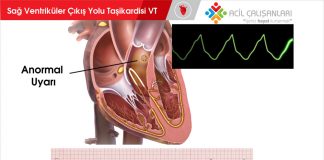 Sağ Ventriküler Çıkış Yolu Ventriküler Taşikardi