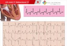 Çift yönlü Ventriküler Taşikardi ( Bidirectional VT )