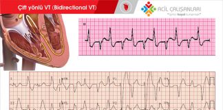 Çift yönlü Ventriküler Taşikardi ( Bidirectional VT )