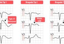 Brugada Sendromu Acil Yaklaşım