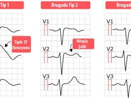 Brugada Sendromu Acil Yaklaşım