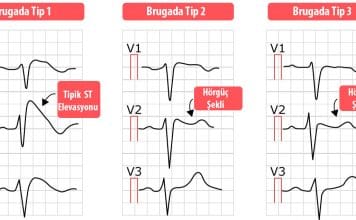 Brugada Sendromu Acil Yaklaşım