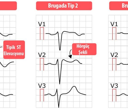 Brugada Sendromu Acil Yaklaşım