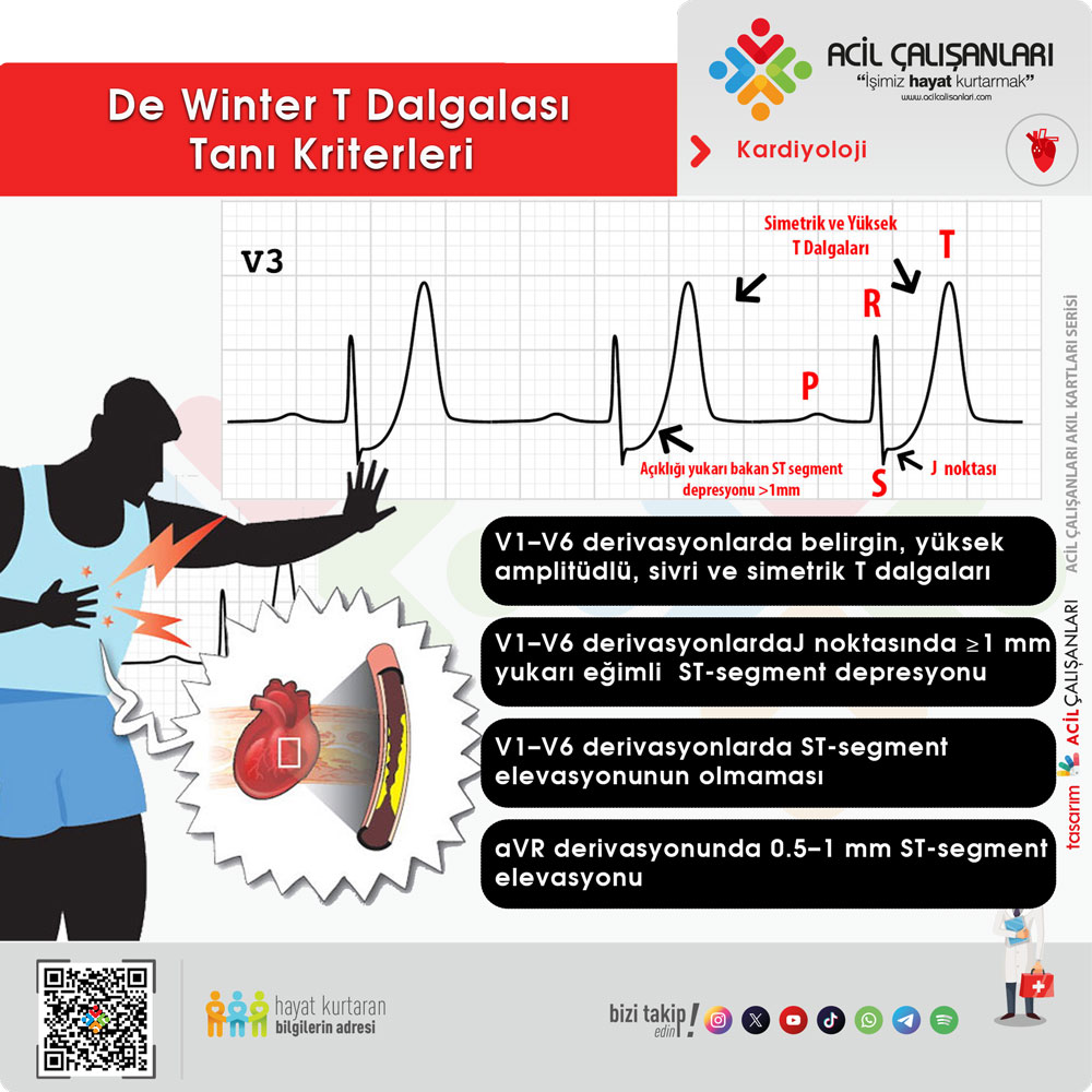 De Winter Tanı Kriterleri