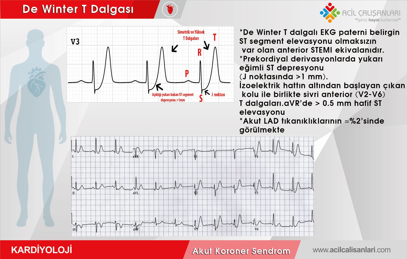 синдром велленса на экг