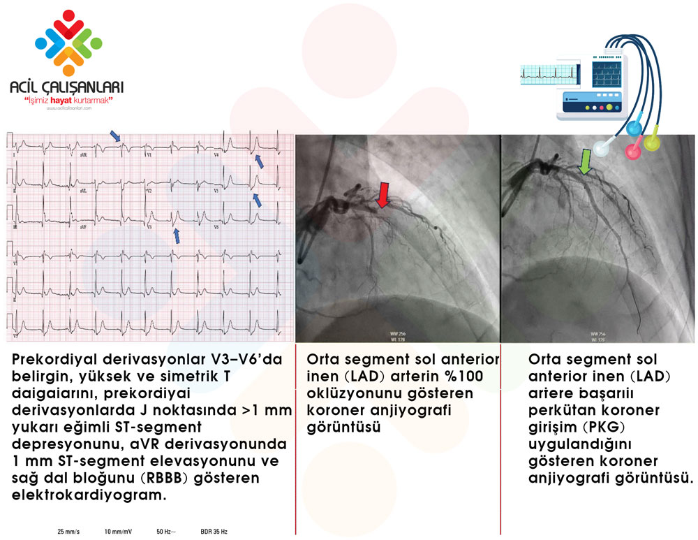 De Winter EKG Örneği 2