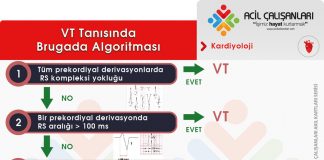 Brugada Algoritması Ventriküler Taşikardi (VT)