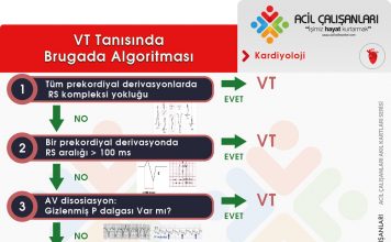Brugada Algoritması Ventriküler Taşikardi (VT)