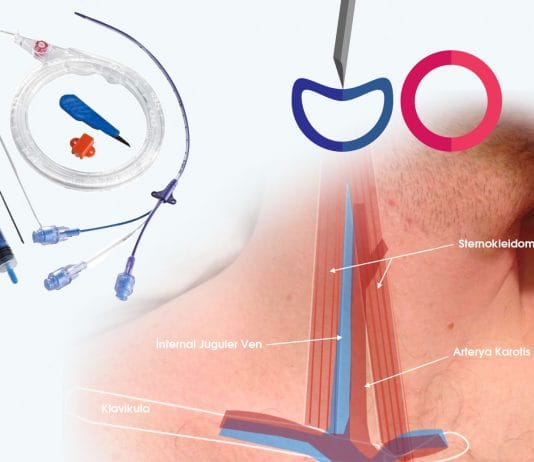 Santral Venöz Kateterizasyon