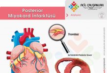 Posterior Miyokard İnfarktüsü