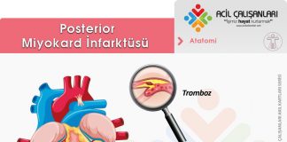 Posterior Miyokard İnfarktüsü