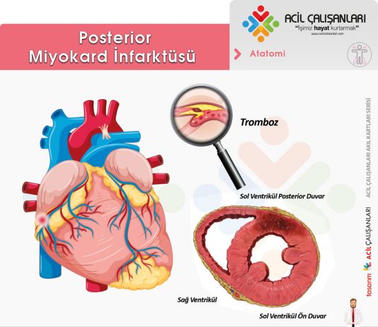 Posterior Miyokard İnfarktüsü