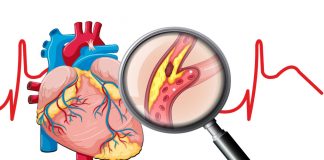 Anterior Miyokard İnfarktüsü