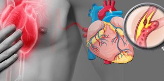 İnferior Miyokard İnfarktüsü