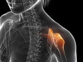 Anterior Omuz Çıkığı