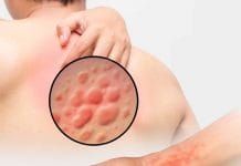 Türkiye Ürtiker Tanı ve Tedavi Kılavuzu-2016