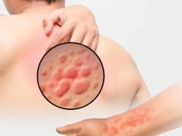 Türkiye Ürtiker Tanı ve Tedavi Kılavuzu-2016