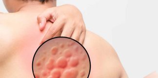 Türkiye Ürtiker Tanı ve Tedavi Kılavuzu-2016