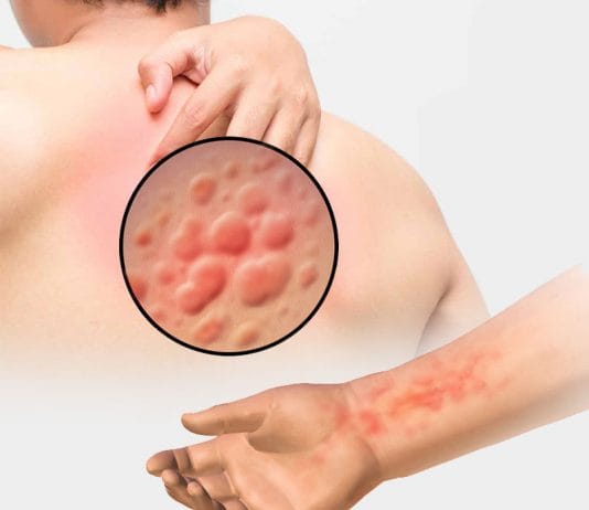 Türkiye Ürtiker Tanı ve Tedavi Kılavuzu-2016