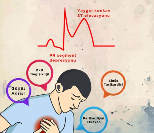 Perikardit Acil Yaklaşım