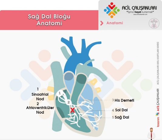 Sağ Dal Bloğu (RBBB)