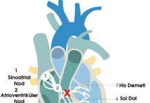Sol Dal Bloğu (LBBB)