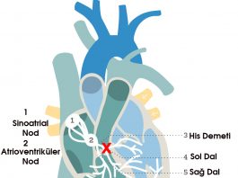 Sol Dal Bloğu (LBBB)
