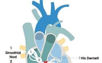 Sol Dal Bloğu (LBBB)