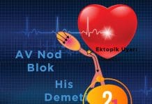 2. Derece Atriyoventriküler (AV) Blok , Mobitz Tip 1 (Wenckebach Fenomeni)