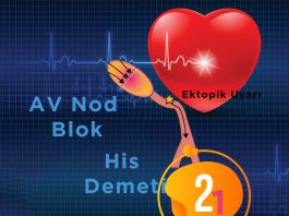 2. Derece Atriyoventriküler (AV) Blok , Mobitz Tip 1 (Wenckebach Fenomeni)