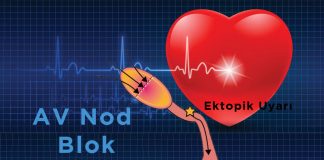 2. Derece Atriyoventriküler (AV) Blok , Mobitz Tip 1 (Wenckebach Fenomeni)