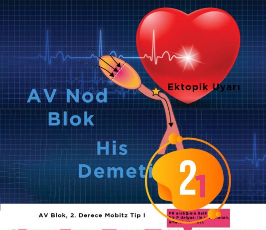 2. Derece Atriyoventriküler (AV) Blok , Mobitz Tip 1 (Wenckebach Fenomeni)