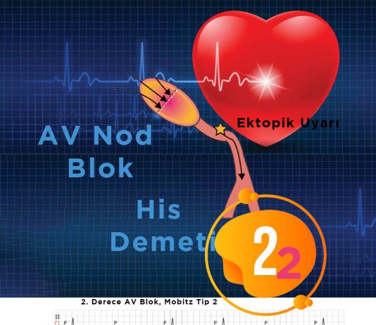 2. Derece Atriyoventriküler (AV) Blok , Mobitz Tip 2