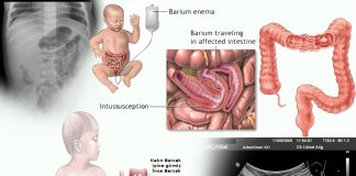 İnvajinasyon ( İntussusepsiyon )