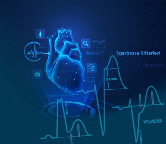 Sgarbossa Kriterleri Sol Dal Bloğu – Miyokard İnfarktüsü Tanısı