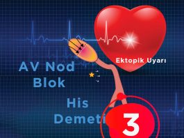 3. Derece Atriyoventriküler (AV) Blok (Tam Kalp Bloğu)