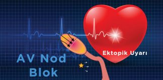 3. Derece Atriyoventriküler (AV) Blok (Tam Kalp Bloğu)