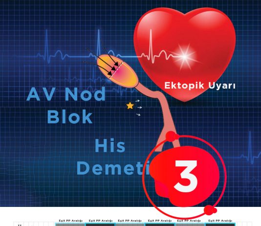 3. Derece Atriyoventriküler (AV) Blok (Tam Kalp Bloğu)