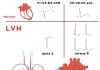 Sol Ventriküler Hipertrofi (LVH)