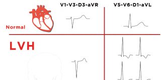 Sol Ventriküler Hipertrofi (LVH)
