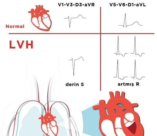 Sol Ventriküler Hipertrofi (LVH)