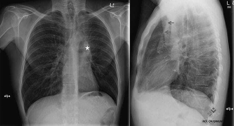 Luftsichel İşareti
