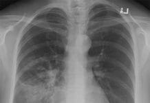 Silüet İşareti Nedir?