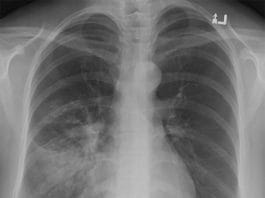 Silüet İşareti Nedir?