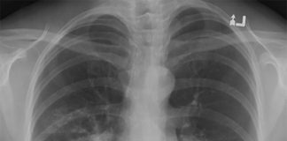 Silüet İşareti Nedir?